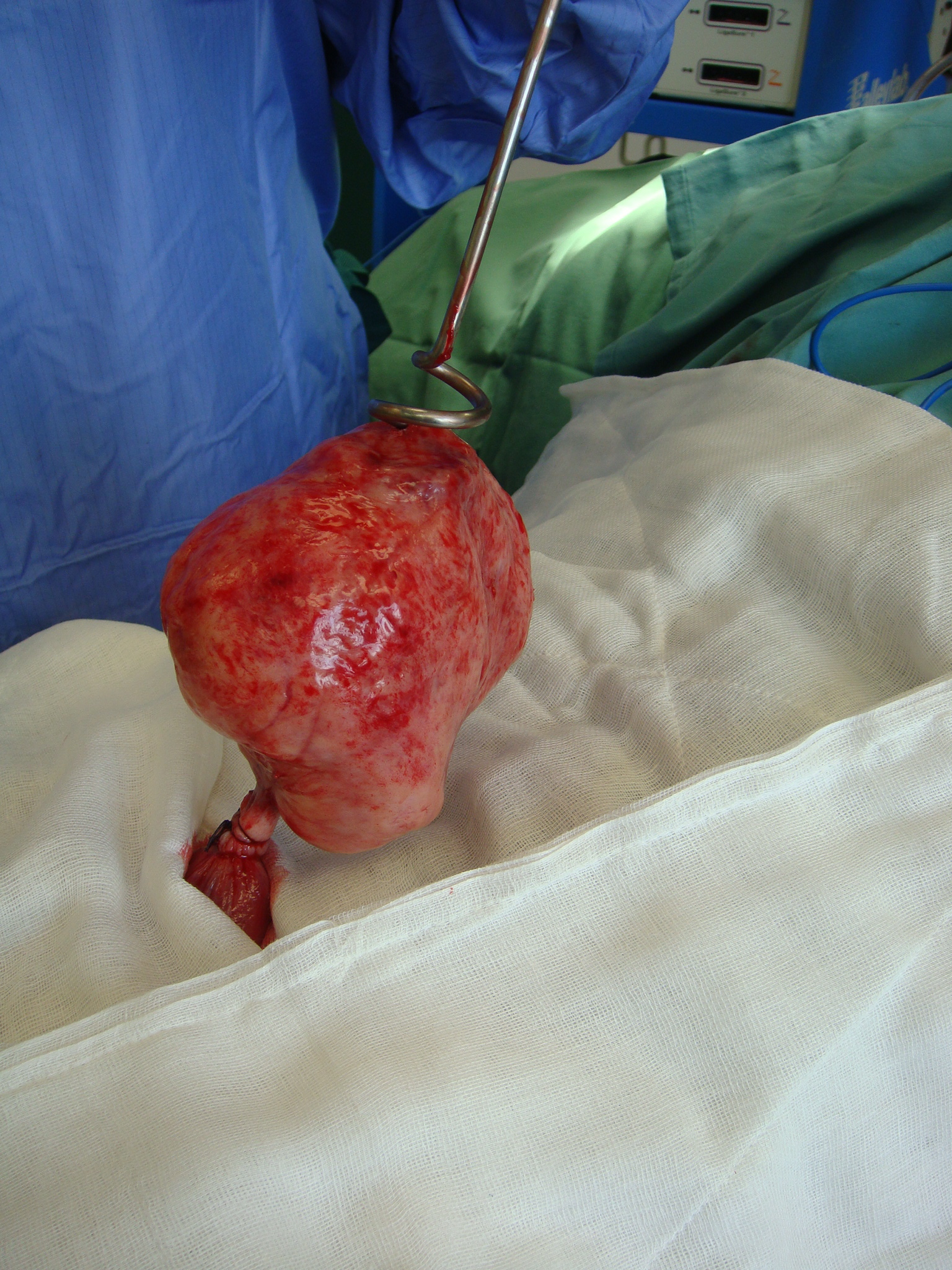 fibroid myomectomy pedunculated